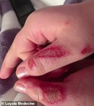 Nine-Year-Old's Microwaving of Sensory Toy in TikTok Trend Causes Severe Burns