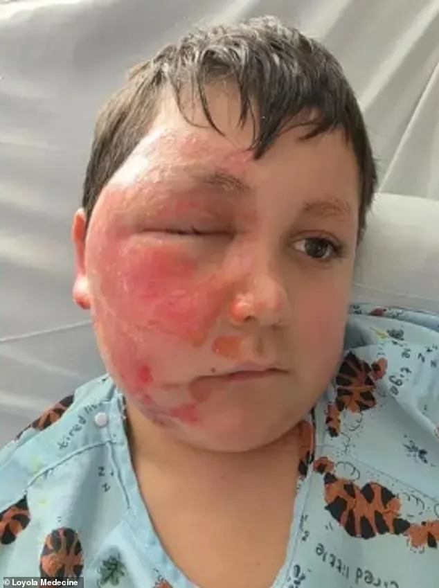 14-Year-Old Rushed to Hospital with Severe Burns After Attempting TikTok Fire-Breathing Challenge
